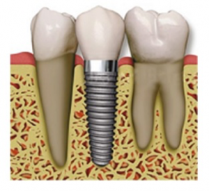 zubni_implantaty