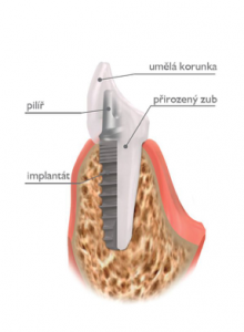 zubni_implantaty1